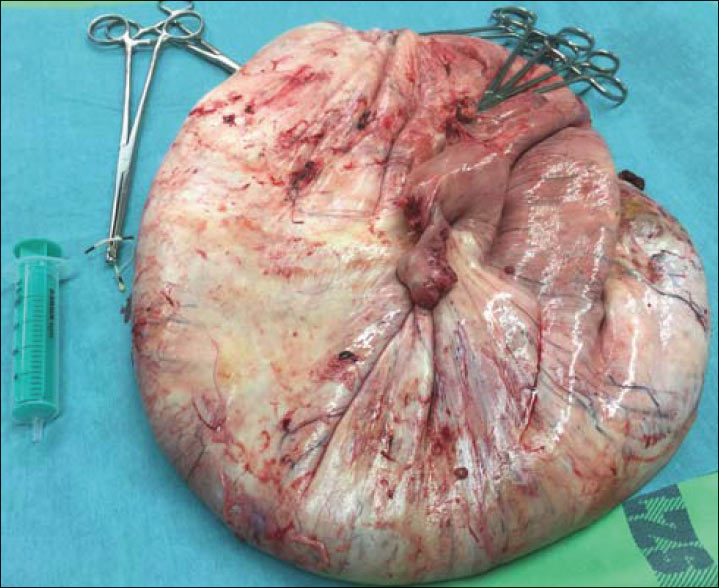 Figure 3. The removed histopathological specimen