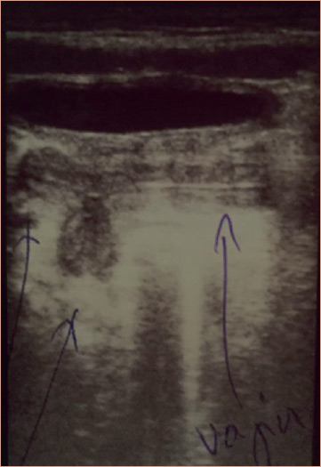 Figure 4: Ultrasound after surgery