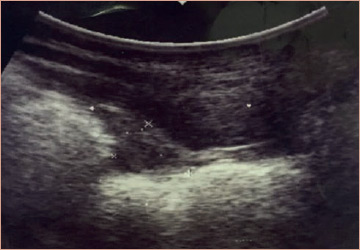 Figure 5: The ultrasound performed 2,5 years after surgery